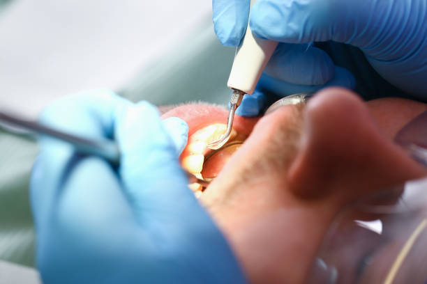 Best Emergency Root Canal Treatment in Ransom Canyon, TX