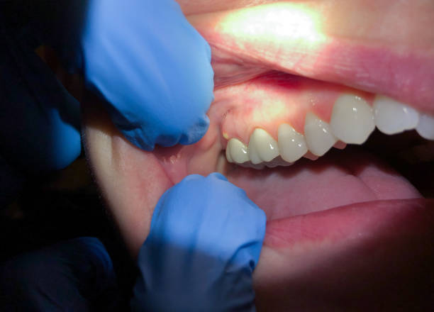 Best Emergency Broken Tooth Repair in Ransom Canyon, TX
